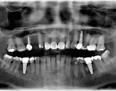 8 signs that you need dental implants