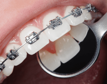 Affordable braces near me