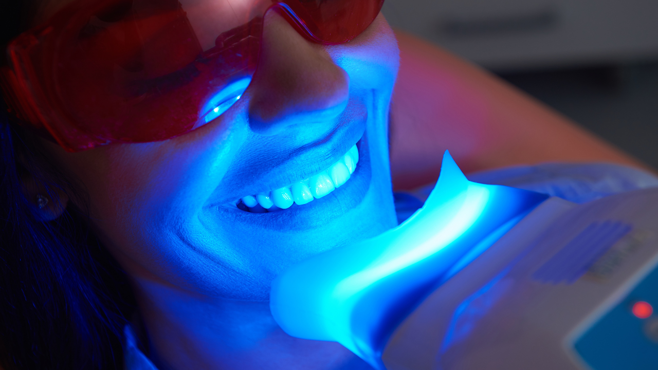 Professional teeth whitening in Tijuana with Zoom technology