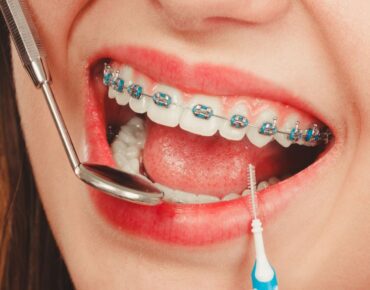 braces problem solution - Braces Tijuana