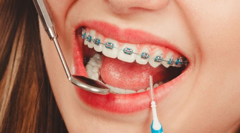 braces problem solution - Braces Tijuana