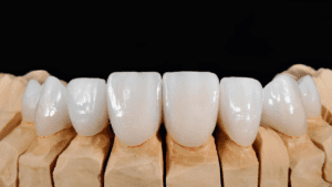 Types dental veneers