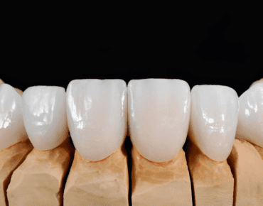 Types dental veneers