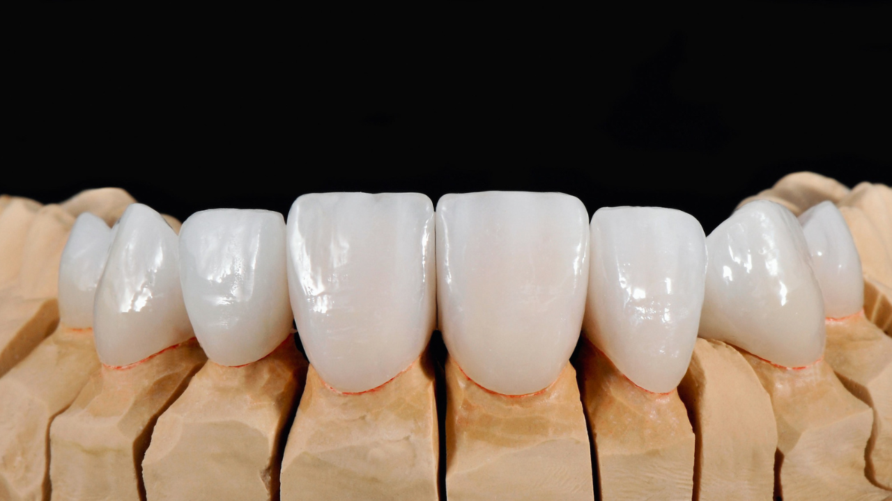 Porcelain Dental Veneers in Tijuana