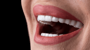 Veneers in Tijuana