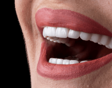 Veneers in Tijuana