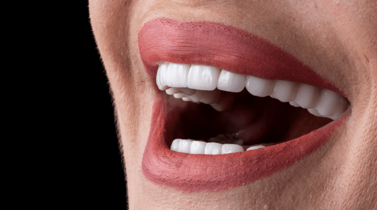 Veneers in Tijuana