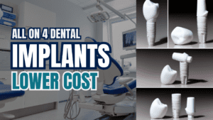 All on 4 Dental Implants Lowest Cost