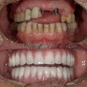 all-on-4 dental implants teeth in a day why dental implants signs you need dental implants afford dental implants