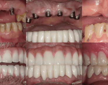 all-on-4 dental implants