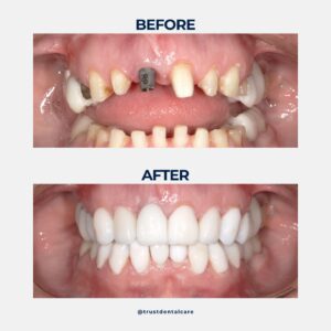 dental crown near me temporary crown 4 types of dental implants temporary crowns vs permanent crown