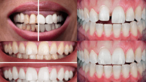 mexican dentist near me Cosmetic porcelain veneers walk in dentist mear me