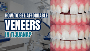 veneers in tijuana price