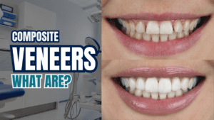 what are composite veneers