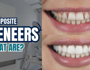 what are composite veneers