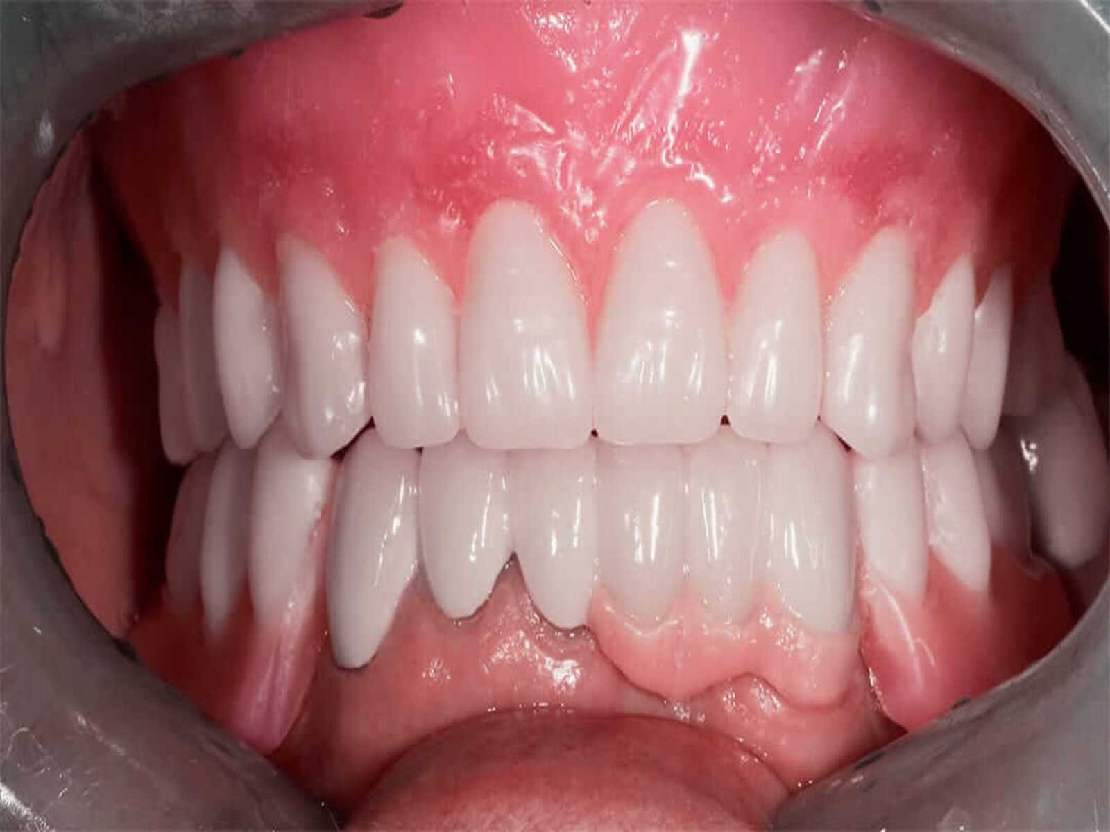 All on 4 Dental Implants Results