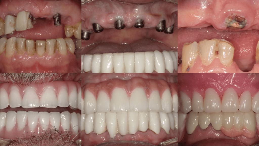 all on 4 dental implants