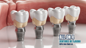 all-on-4 dentures in tijuana