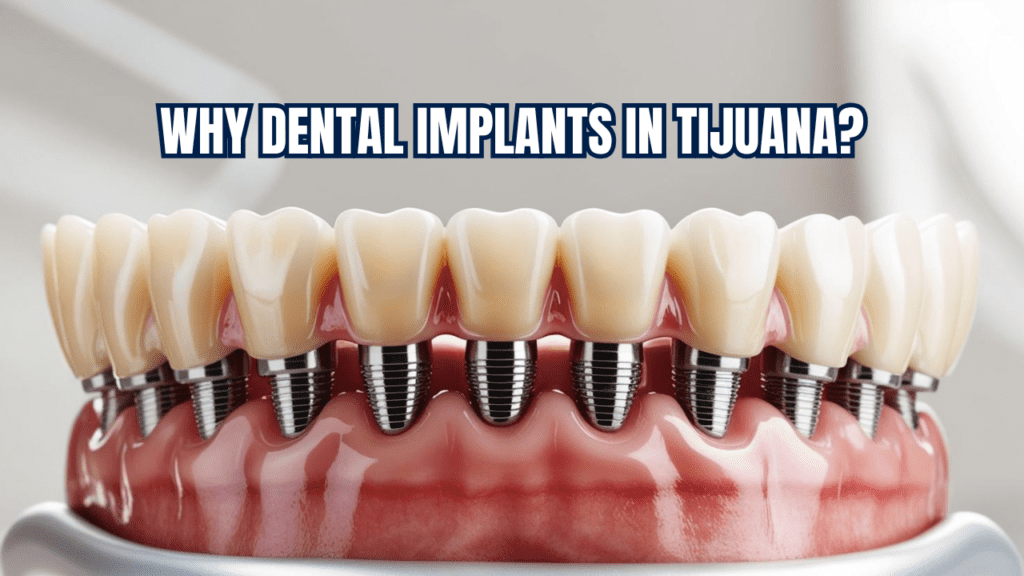 why dental implants in tijuana