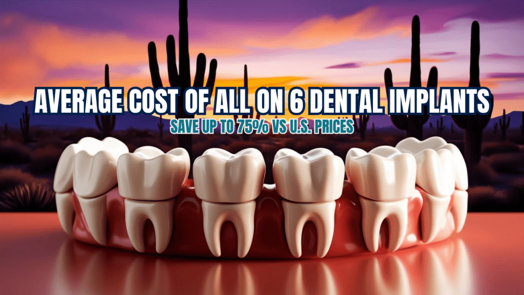 Average Cost of All On 6 Dental Implants