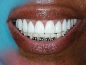 Tijuana Dentist for Dental Implants & Full Mouth Restoration in Mexico 12 Veneers in Tijuana