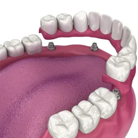 All-on-4 Dental Implant