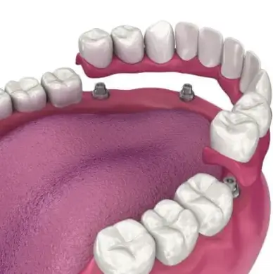 All-On-4 Dental Implants