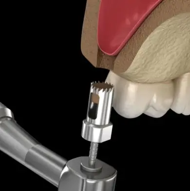 Dental Implants