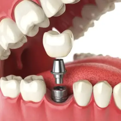 Dental Implants Tijuana