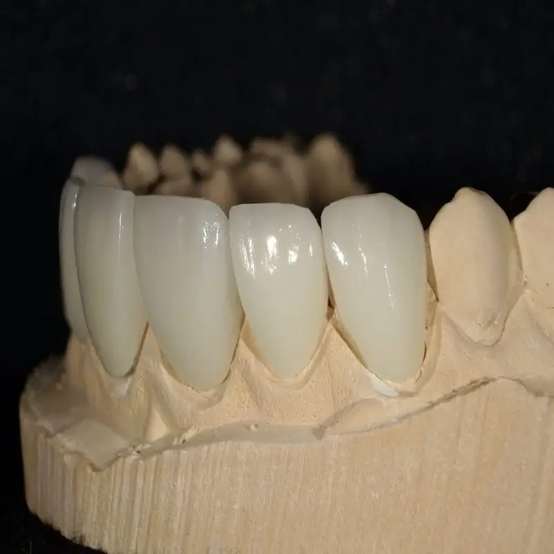 veneers tijuana