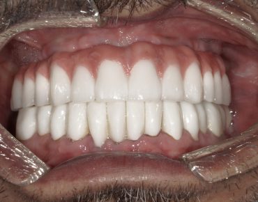 image of teeth after a dental implant