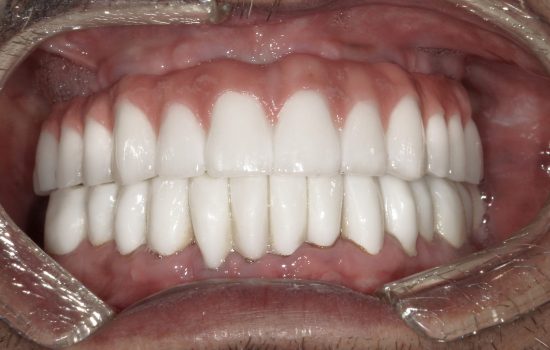 image of teeth after a dental implant