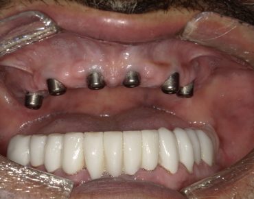 image of teeth after a dental implant