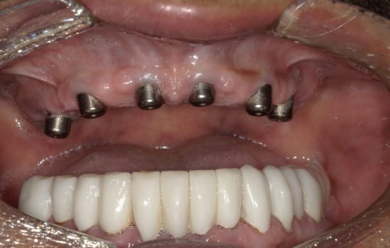 image of teeth after a dental implant