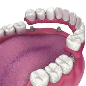 All on Dental Implant Types of Implants