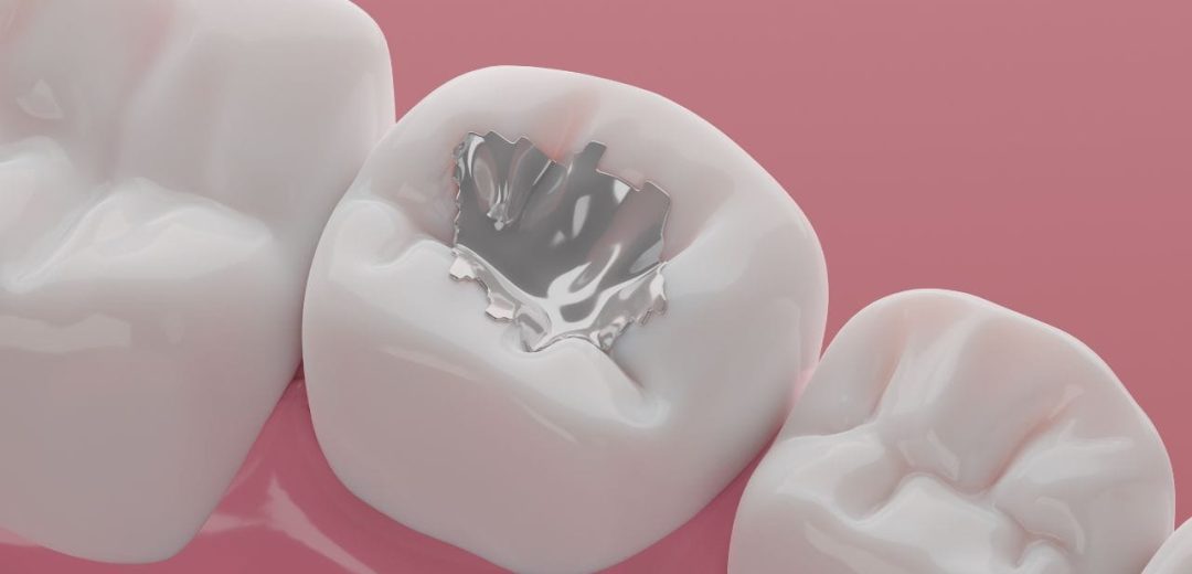 Amalgam Fillings