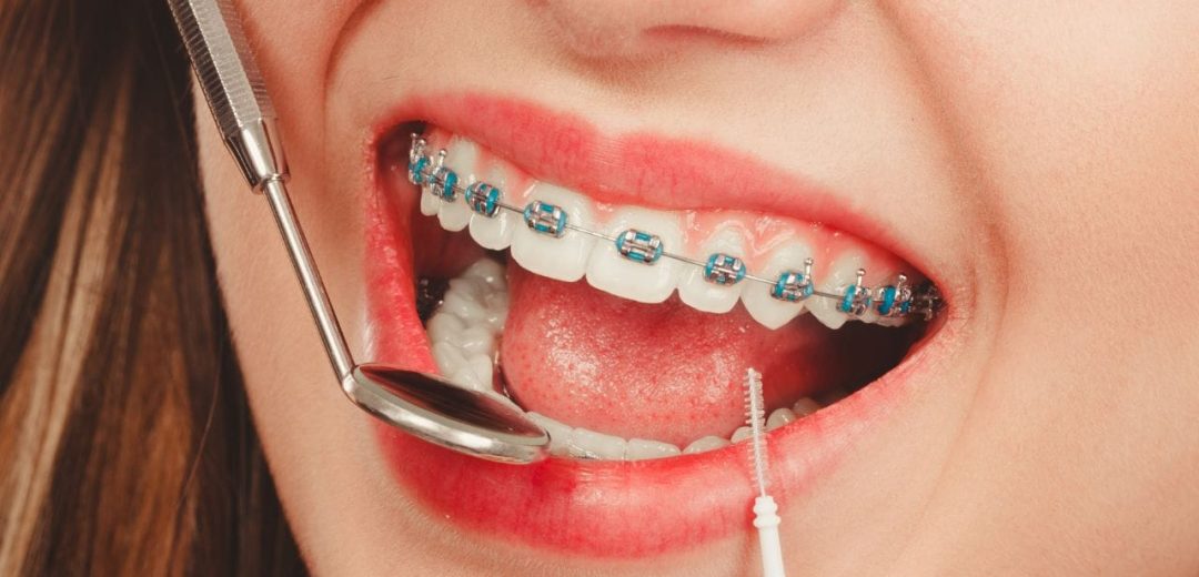 Dental Braces