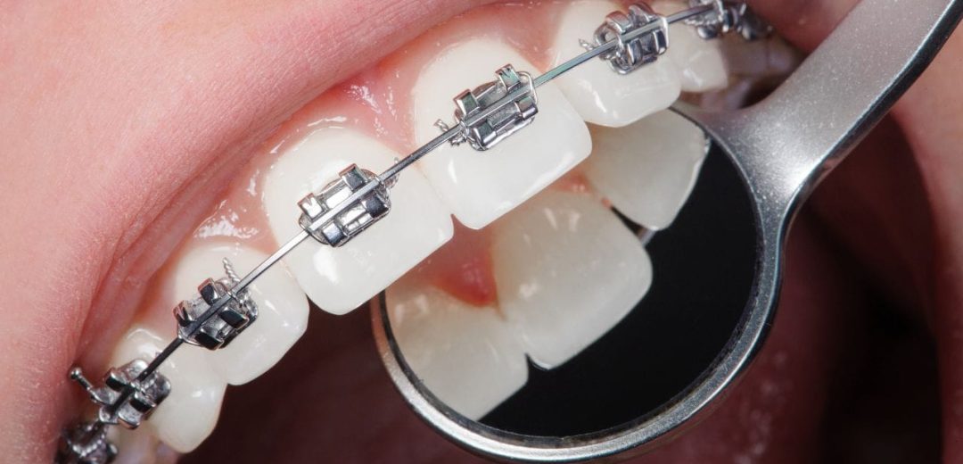 Braces in Tijuana