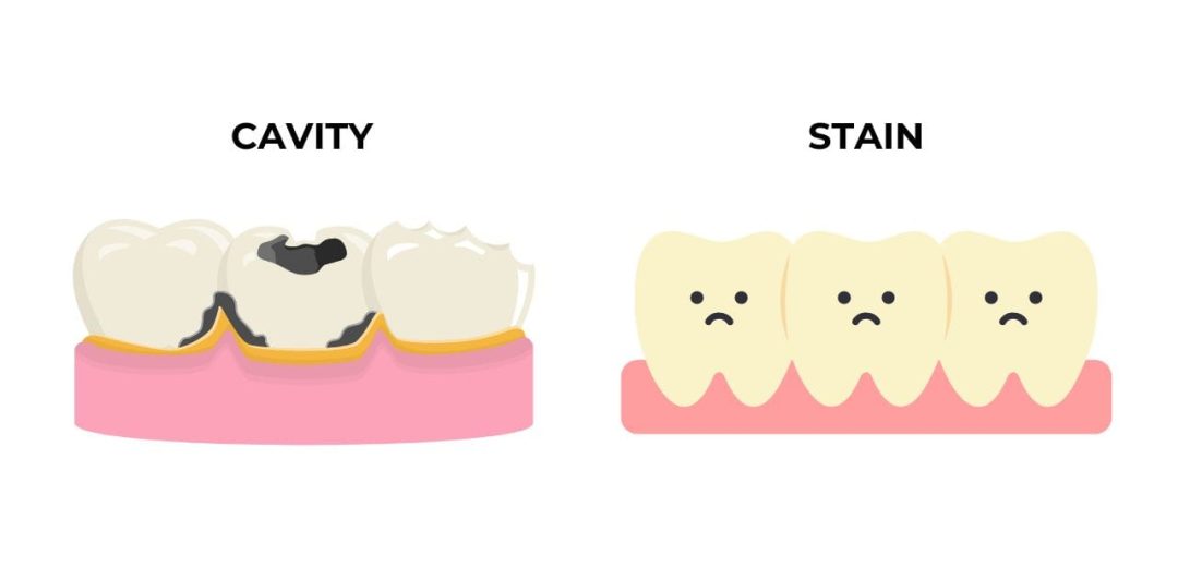 Cavity vs Stain