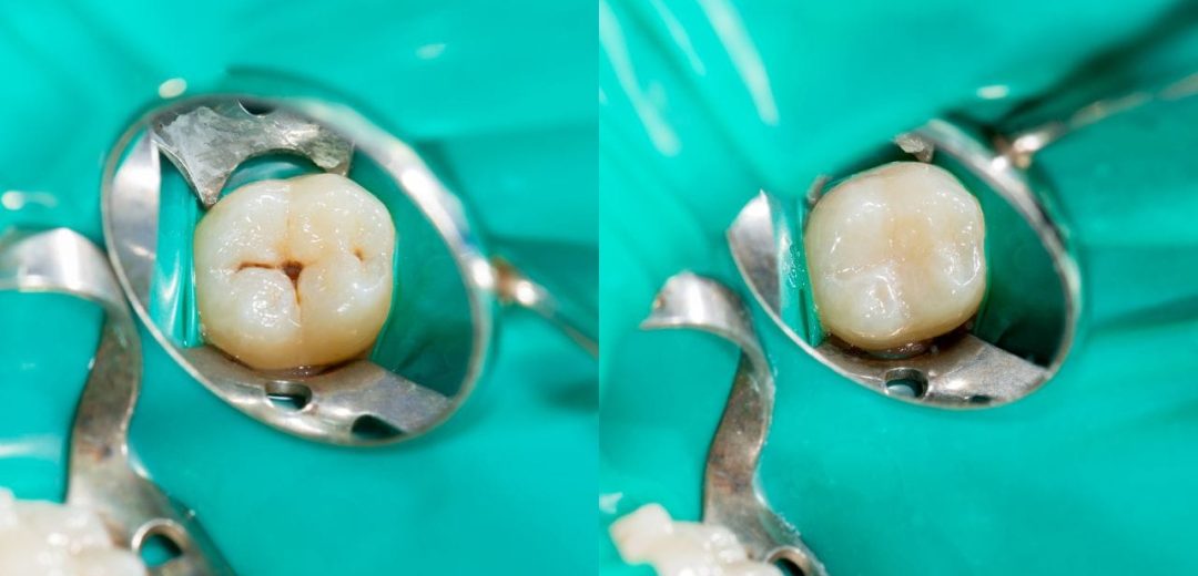 Composite Fillings