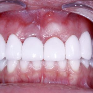 Image of teeth after Dental Implants procedure