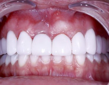 Image of teeth after Dental Implants procedure