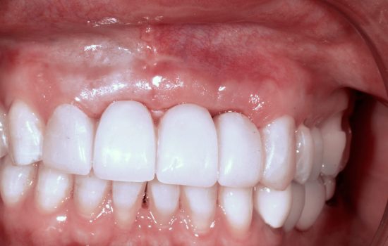 Image of teeth after Dental Implants procedure