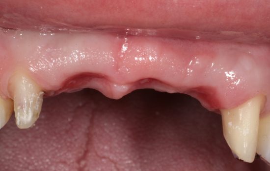 image of teeth after a dental implant