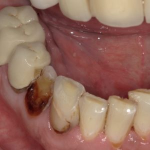 image of teeth after Dental Crowns procedure