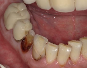 image of teeth after Dental Crowns procedure