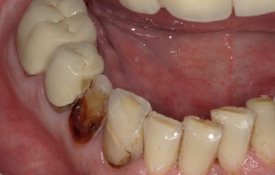 image of teeth after Dental Crowns procedure