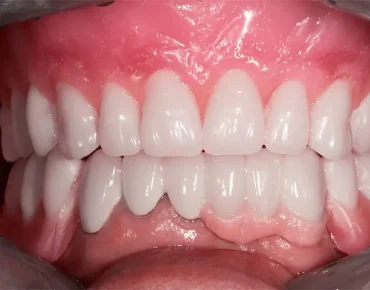 image of teeth after a all on 4 dental implant Mexico