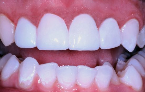 Dental Veneers After Tijuana