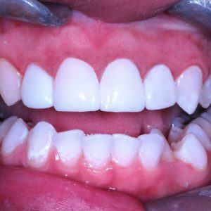 image of teeth after veneers